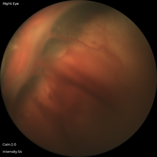 Phoenix Retina Camera Rop ROP RE image